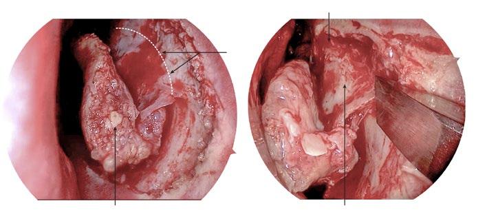 20 Hands-On Dissection Guide on Advanced Endonasal Endoscopic Sinus Surgery W W Fig. 5.2c, d c.