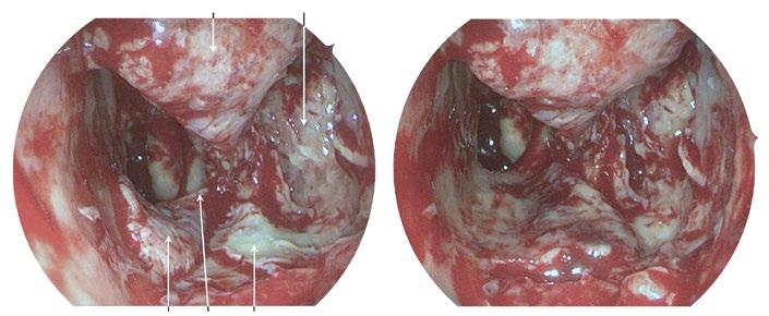 Step 4: Prelacrimal Approach to the Maxillary Sinus / Medial Maxillectomy 21 E W E R W Y Fig. 5.2i, j i.