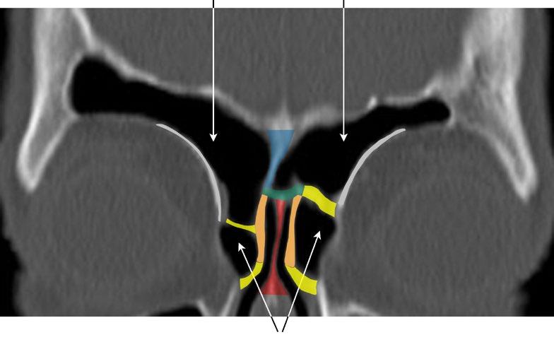 Step 5: Frontal Sinus Drainage Type III 25 W E Fig. 6.3 Alternative options of bone resection procedures in endonasal endoscopic frontal sinus drainage procedures of type II and III.
