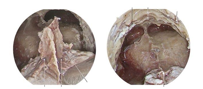 Step 5: Frontal Sinus Drainage Type III 27 W W Fig. 6.4g, h g.