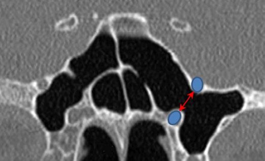 30 Hands-On Dissection Guide on Advanced Endonasal Endoscopic Sinus Surgery Fig. 7.3 Frontal CT scan revealing a well-pneumatized sphenoid sinus (refer to left side).