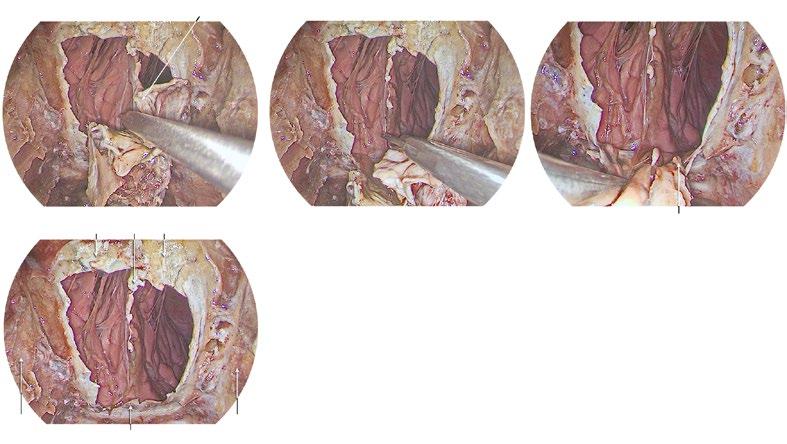 36 Hands-On Dissection Guide on Advanced Endonasal Endoscopic Sinus Surgery i j k W l E R E Fig. 8.2i l (Continued from page 35) i.