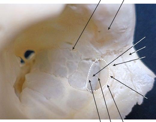 8 Hands-On Dissection Guide on Advanced Endonasal Endoscopic Sinus Surgery W T Fig. 2.1 Macroscopic lateral view of the right lacrimal fossa and adjacent craniofacial bones.