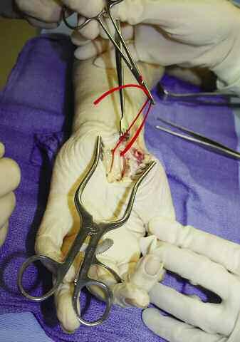 Operative Technique Step 1: Prepare the Nerve Under magnification, an incision is made over the injured nerve. The incision is extended proximally and distally.