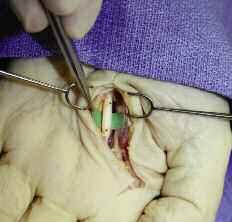 Although the NeuroMend Wrap conduit is designed to maintain closure, a suture is recommended,