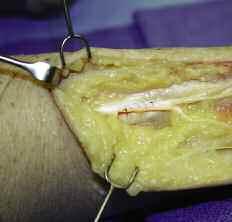 One suture is placed on each end of the NeuroMend Wrap.