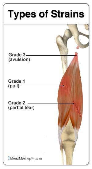 MUSCLE INJURIES Muscle Strain: when a muscle is stretched beyond its usual limits Grade I Mild, tightness in the muscle the day after Grade