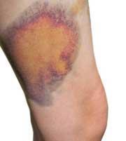 MUSCLE INJURIES Contusion: bruise or bleeding within the muscle resulting from an impact Ex.