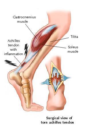 MUSCLE INJURIES Tendinitis: inflammation of a tendon usually causing pain and swelling Acute and overuse injuries Can occur with aging as elasticity decreases Can occur in any
