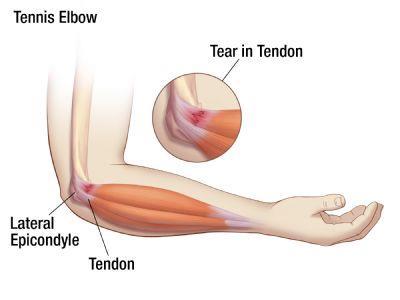 MUSCLE INJURIES Overuse injuries to the elbow: inflammation and sometimes