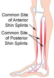 MUSCLE INJURIES Shin Splints: localized pain in the medial lower leg Overuse injury that typically arises from running or dancing on a hard surface Believed to be