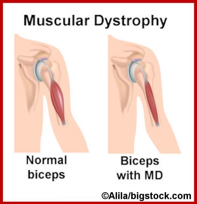 MUSCLE DISORDERS Muscular Dystrophy: progressively worsening muscle weakness and loss of muscle tissue May occur in childhood or adulthood Some forms affect a
