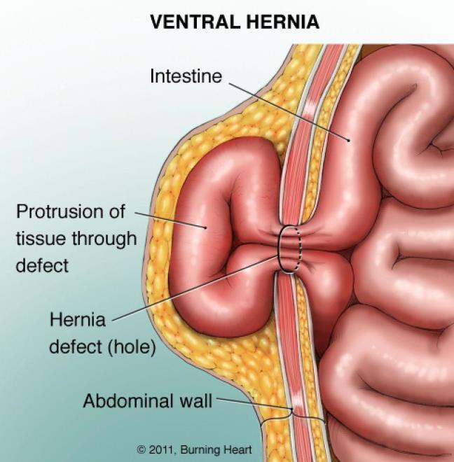 MUSCLE DISORDERS Hernia: balloon-like section of the abdominal cavity lining that protrudes through a whole or weakened section of the muscle in the abdomen Can be caused by heavy lifting or by any