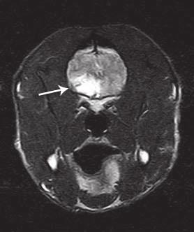 (A) Transverse CT scan showing a contrast-enhanced mass in the olfactory lobe (arrow). (B) Sagittal CT image highlighting the mass (arrow). Benzodiazepines (e.g., midazolam) decrease cerebral blood flow and ICP.