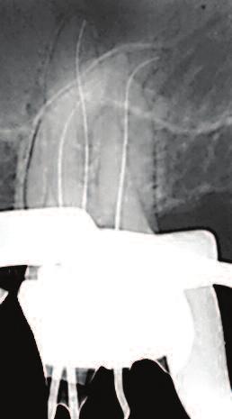 A length determination radiograph (Figure 15b) revealed a curvature in the middle third of the mesiobuccal root canal, a small curvature in the