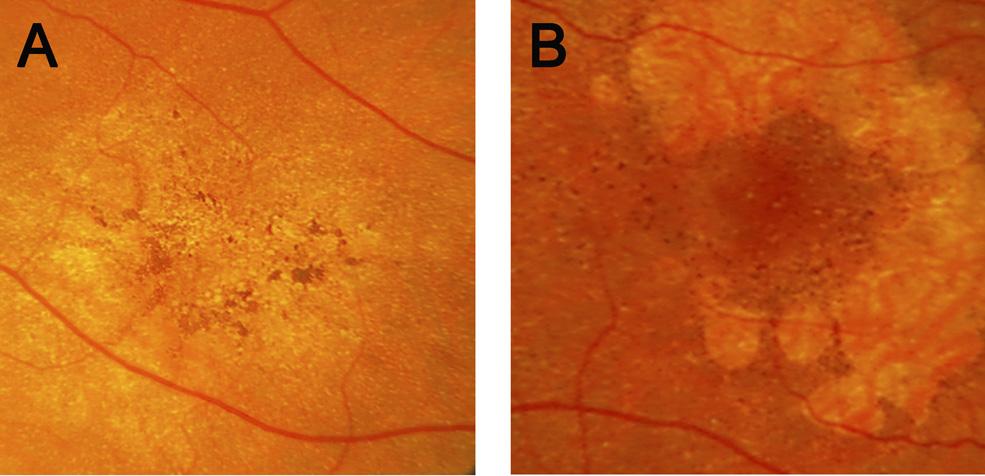 IOVS, May 2011, Vol. 52, No. 6 FAF and SD-OCT in Rapidly Progressing GA 3763 and four eyes with the diffuse-fine granular with peripheral punctuate spots FAF pattern (6.7%).