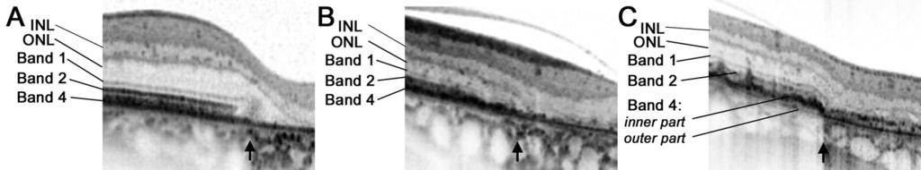 2A, 2B; also seen in fellow eyes that had not developed atrophy [Fig. 2A]), and the borders of the atrophic lesions appeared hyperpigmented (Fig. 2B).