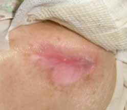 ulcers; it is unknown how long the scapula pressure ulcer had been here.