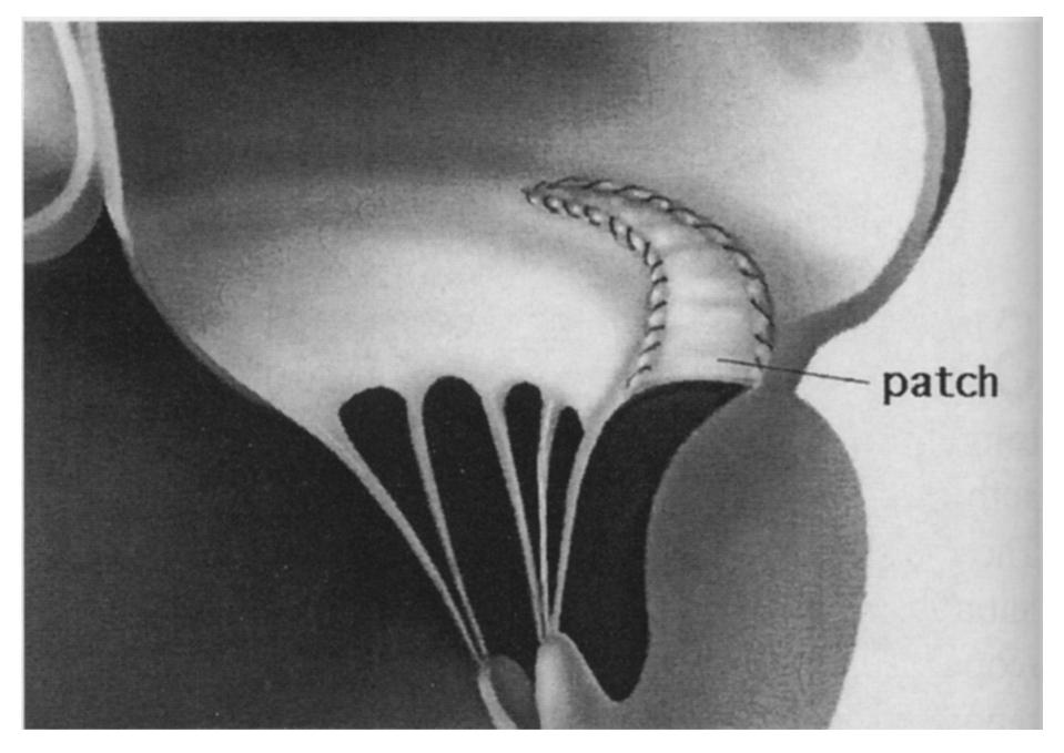 The anterior papillary muscle was the muscle most often involved with hypoplasia.