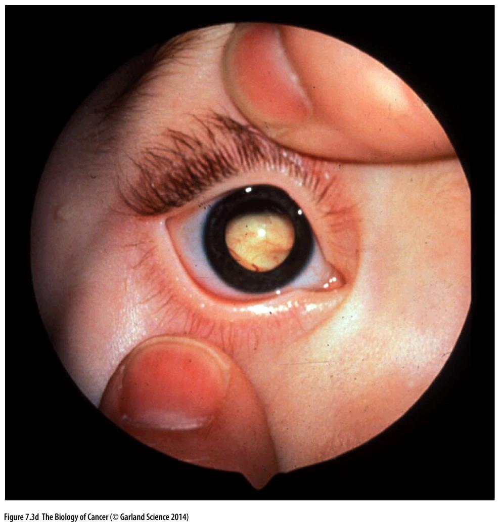 Most treatment by radiafon or removal of the eye Two forms.