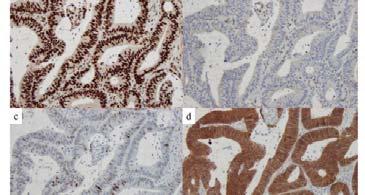 IHC for Tumor tissue for MLH1, MSH2 HNPCC suspected: MSI testing of tumor DNA: Panel of 7 mono and dinucleotide sequences.