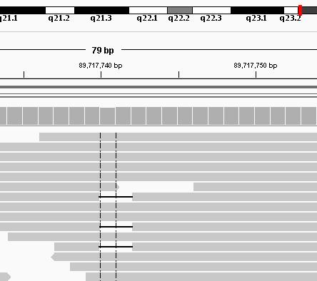 Mosaic Mutations Detected NGS del AG Sanger PTEN 2bp