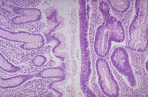 Adenomas benign epithelial neoplasia exophytic growth pattern atypic nuclei