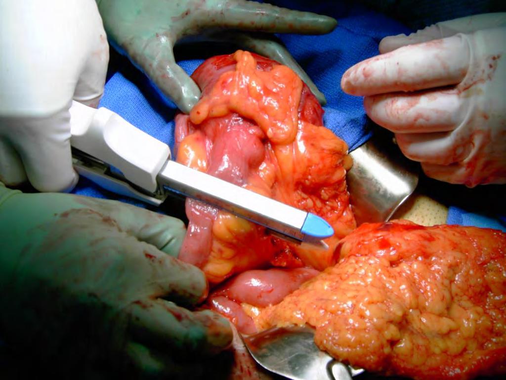 COLECTOMY: