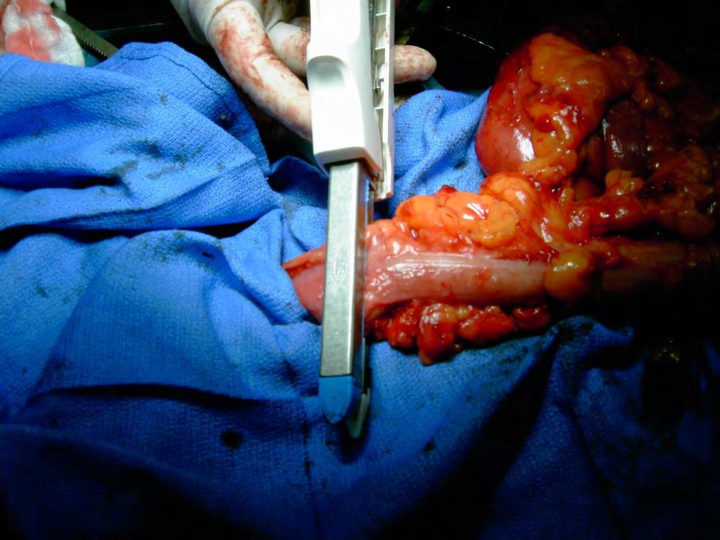 COLECTOMY: