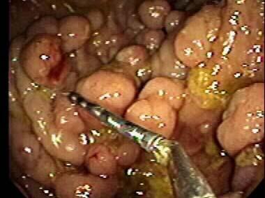 increases with number of adenomas If untreated 100%
