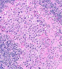 8. Anaplastic Lymphoma Kinase-positive large B-cell lymphoma Tumor cells bear