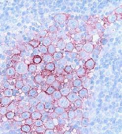 Most cases express clathrin-alk fusion protein and a few cases express the