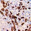 The V600E mutation is a likely driver mutation in 100% of cases of hairy cell leukemia.