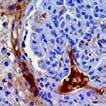 Application: Melanoma & Skin Cancer ALK, RMab (EP301) ALK recognizes a human p80 protein, identified as a hybrid of the Anaplastic Lymphoma Kinase (ALK) gene and the Nucleophosmin (NPM) gene