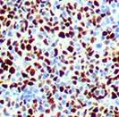 It is positive in AA Amyloidosis and familial Mediterranean fever. Recently, SAA has also been investigated as a potential marker for neoplastic activity.