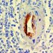 Application: Melanoma & Skin Cancer, Prostate Cancer, Gall Bladder & Pancreatic Cancer, Breast Cancer bcl6, RMab (EP278) Antibodies to the bcl-6 protein stain the germinal center cells in lymphoid