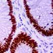 Application: Rejection & Autoimmunity, Lymphoma Cytokeratin 16, RMab (EP297) CK16 expression has been described in neoplasms of multiple tissues.