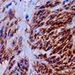 cancers of the lung, stomach, breast, and brain. CD105 may serve as a target for anti-angiogenesis therapy.
