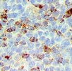 expression in head and neck Squamous Cell Carcinomas and is a poor prognostic indicator in this entity as well.