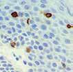 cell lymphomas. Neutrophil elastase is a useful aid for classification of acute myeloid leukemia and extramedullary myeloid cell tumors. Application: Leukemia & Histiocytic NKX3.