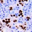 Application: Rejection & Autoimmunity, Melanoma & Skin Cancer PAX-8, RPab (Polyclonal) 2016 New Antibodies for Immunohistochemistry MUC4, MMab (8G7) MUC-4 has been found to play various roles in the