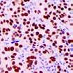 2016 New Antibodies for Immunohistochemistry PAX-8, RMab (EP298) PAX-8 is expressed in the thyroid (and associated carcinomas), non-ciliated mucosal cells of the fallopian tubes and simple ovarian