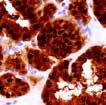 Application: Lymphoma, Hodgkin s and NHD Lymphoma PDX1, RMab (EP139) PDX1 expression has been identified in Pancreatic Ductal Adenocarcinomas and endocrine neoplasms.
