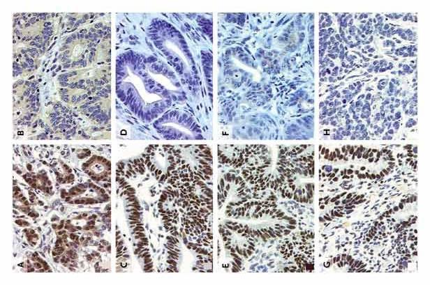 Immunohistochemistry of MMR proteins in CRCs Tested protein: MLH1 MSH2 MSH6 PMS2 MSI-H CRCs (One or more than