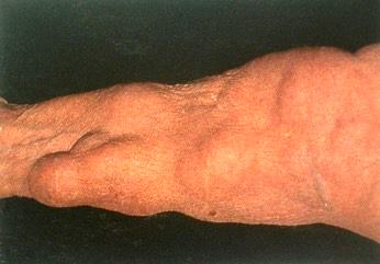 hepatoblastoma, medulloblastoma (Turcot Syndrome) 2.