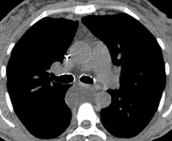 4/12/2018 Enteric Duplication (Gastroenteric) Mediastinal Cysts Probably derived from misplaced foregut rests