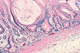 (Hattori) Cysts of the Posterior Mediastinum Paravertebral in location, in women Unilocular, with an epithelial