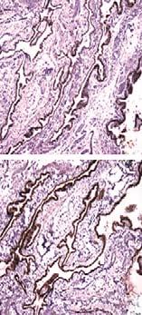 Cholesterol clefts are inconspicuous, and mural lymphoid tissue is