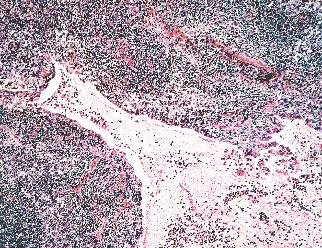 atypical lymphoid tissue containing diagnostic Reed cells or,