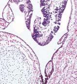 be represented in the lesional tissue Immature